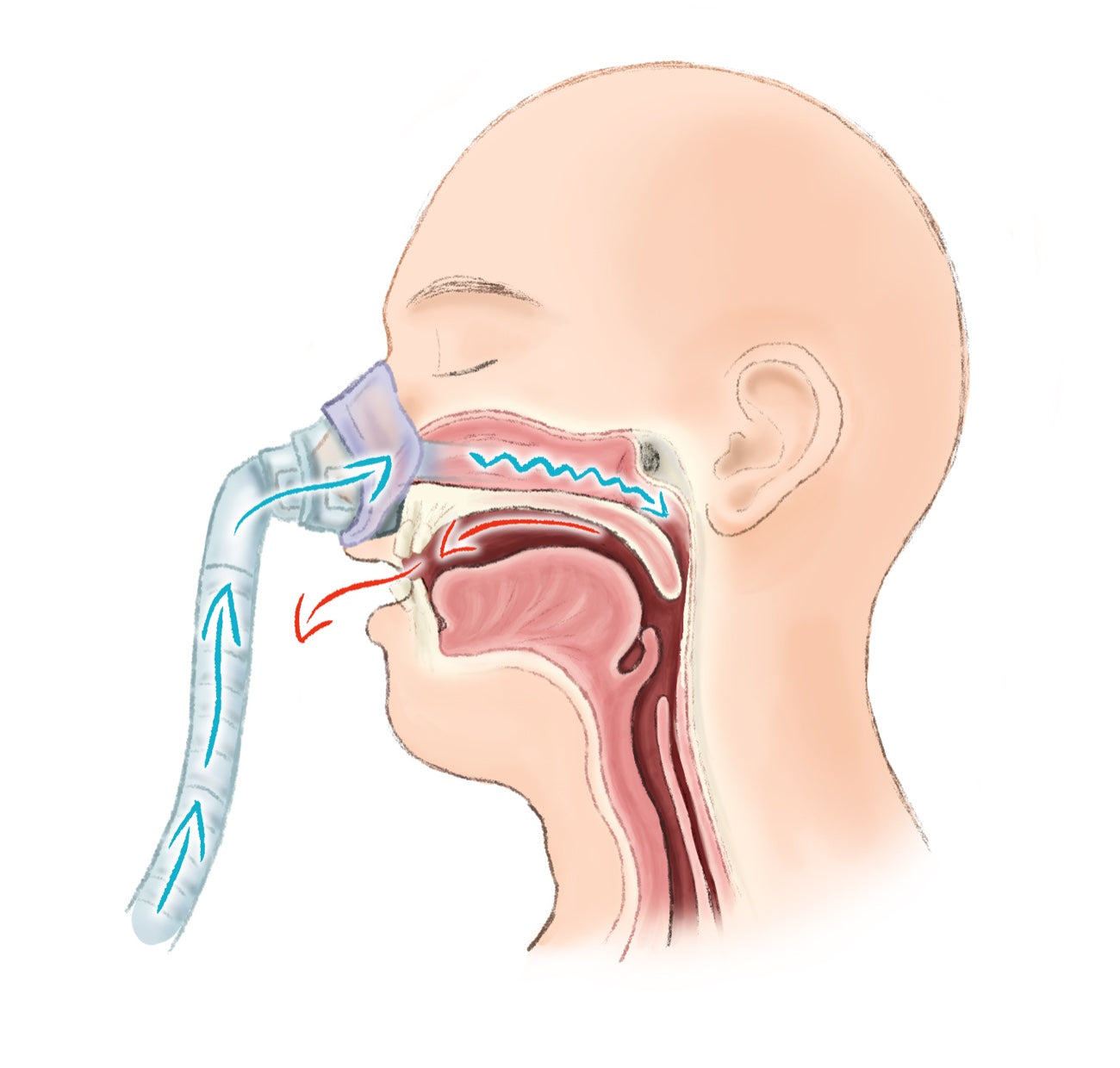 Nasal CPAP airflow — air in through the nose, pressure escaping through an open mouth