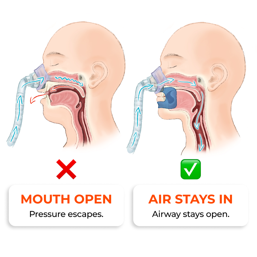 Mouth open — pressure escapes, versus mouth closed — air stays in and the airway stays open