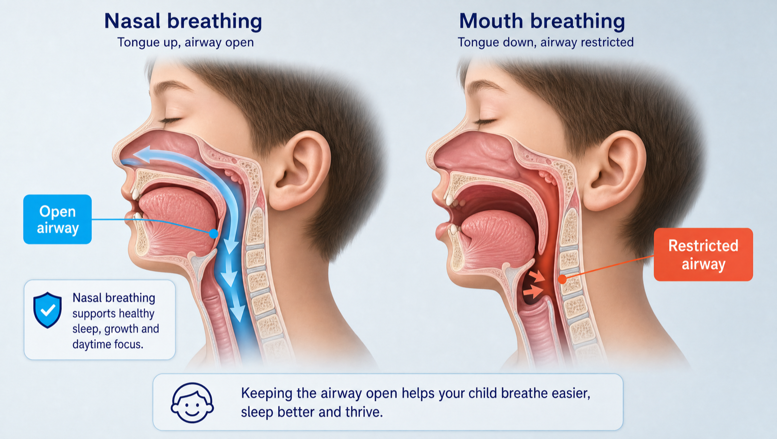 Nasal breathing keeps the airway open with the tongue up; mouth breathing drops the tongue and restricts the airway