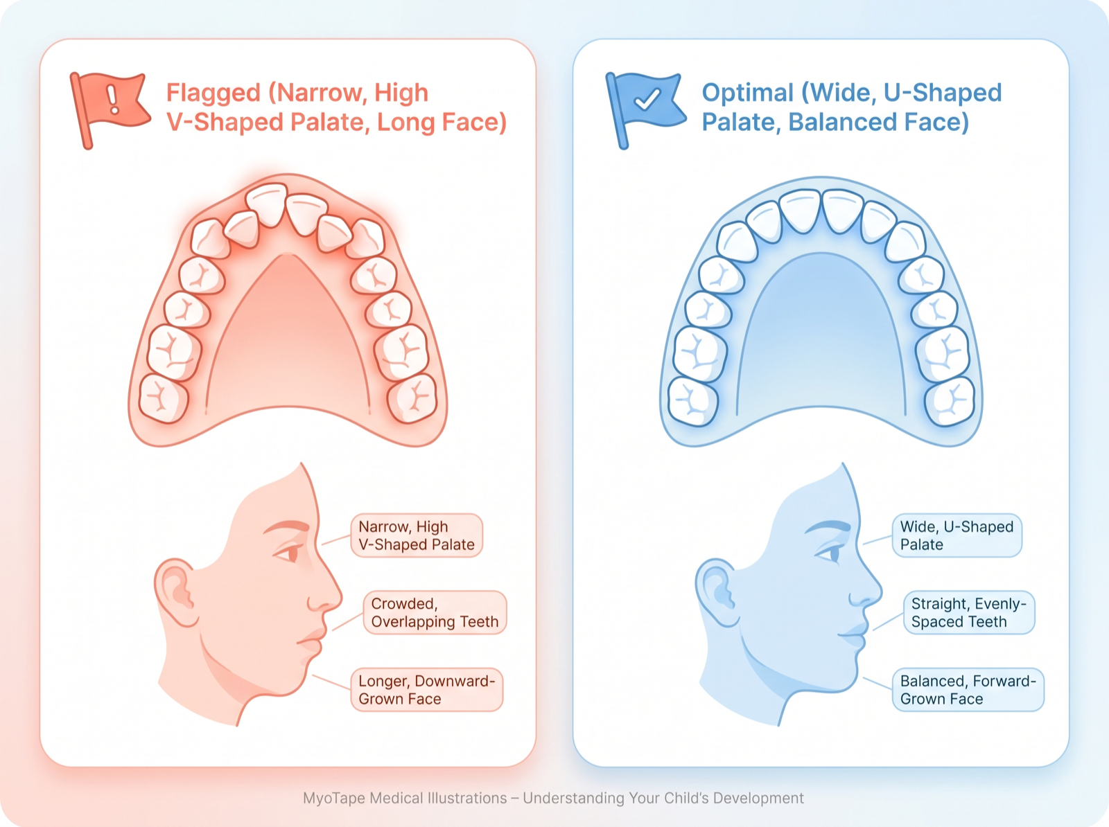 Flagged narrow high V-shaped palate and long face versus optimal wide U-shaped palate and balanced face
