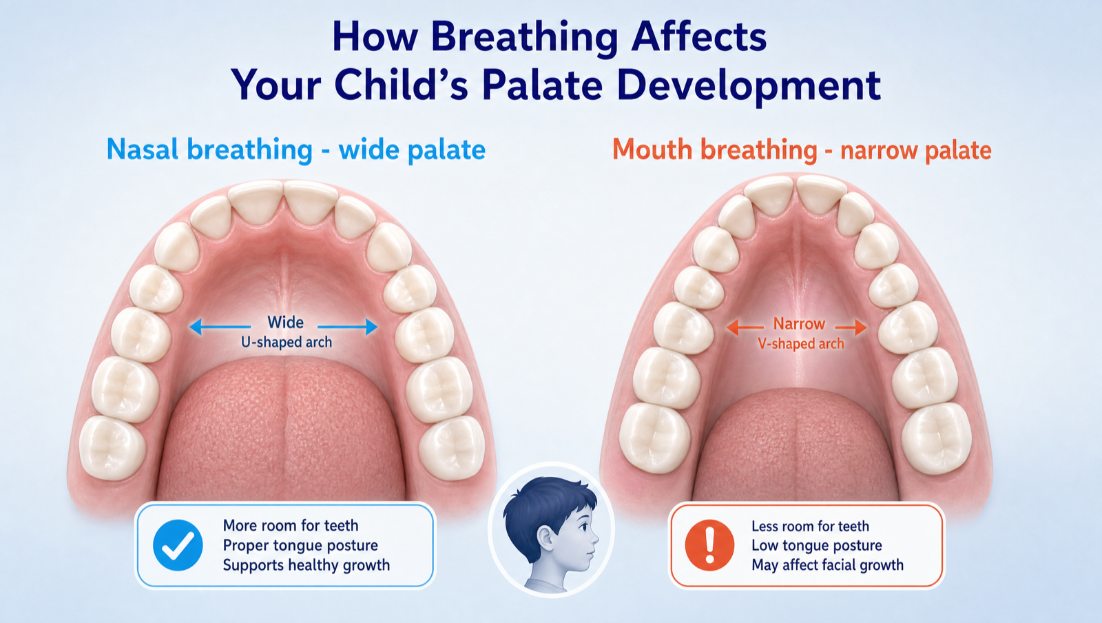 How breathing affects your child's palate development — nasal breathing forms a wide U-shaped arch; mouth breathing a narrow V-shaped arch